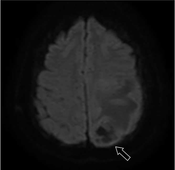 図3．拡散強調画像