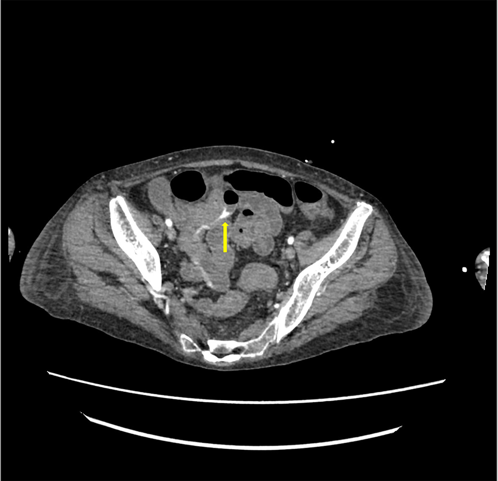図１．動脈相（水平断）