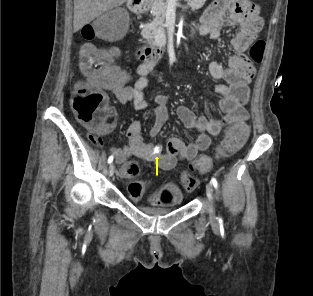 図2．動脈相（冠状断）