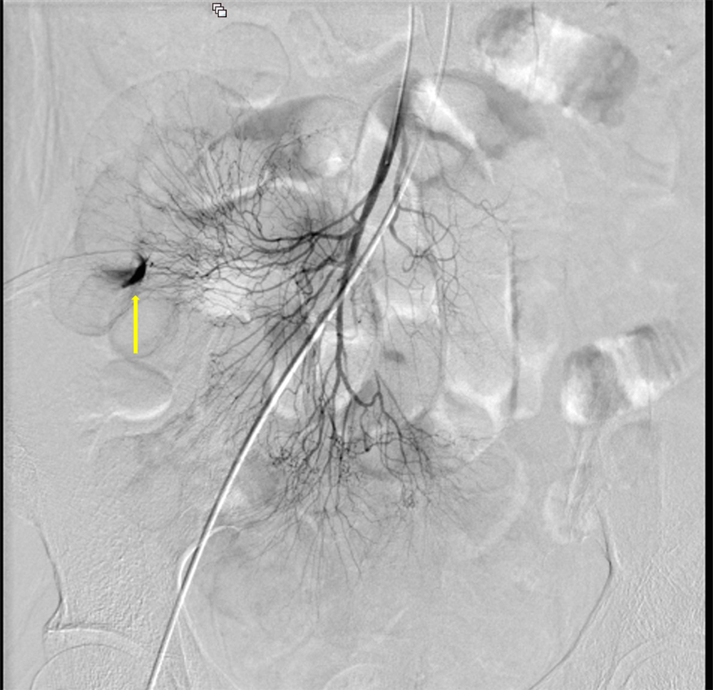 図4．経カテーテル的血管塞栓術