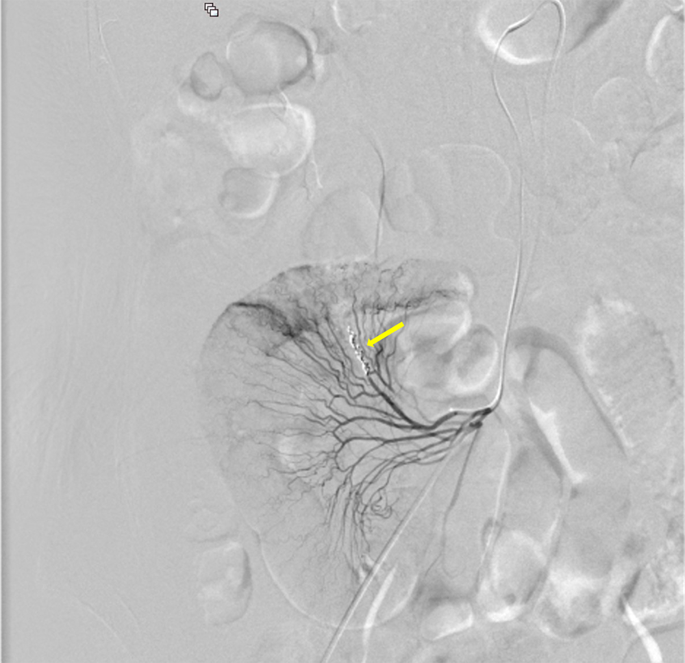 図5．経カテーテル的血管塞栓術
