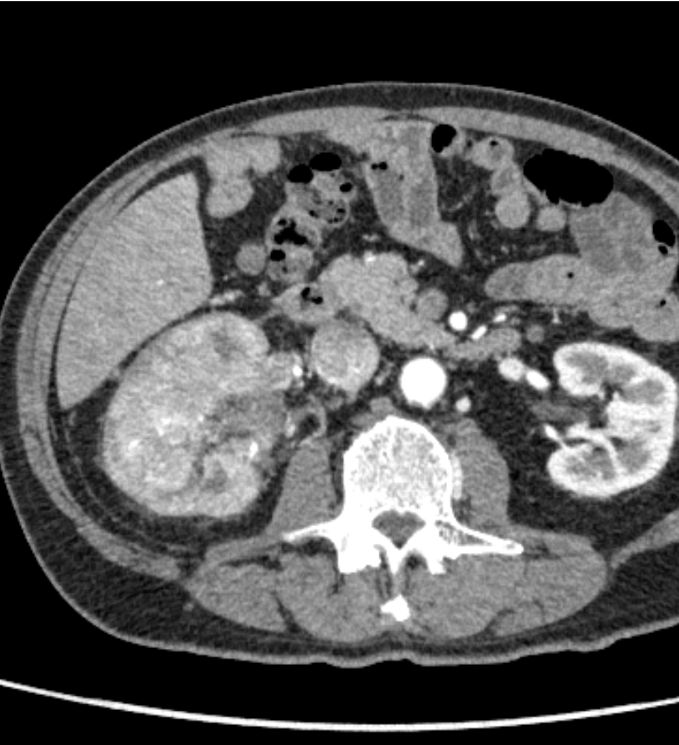 図１．動脈相（横断像）