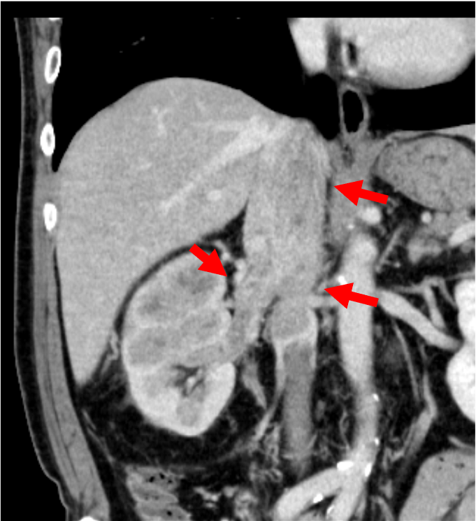 図2．平衡相（冠状断）