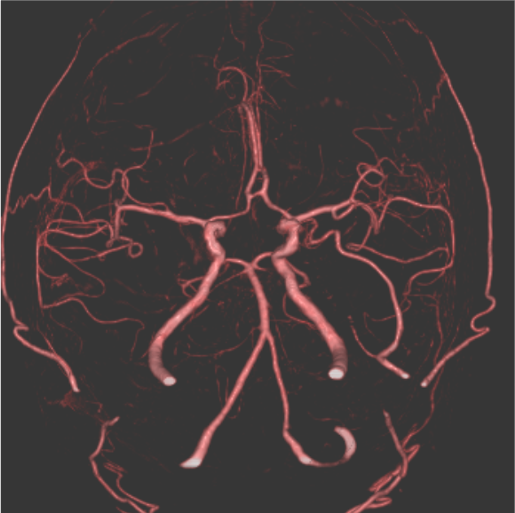 図4．CT angiography