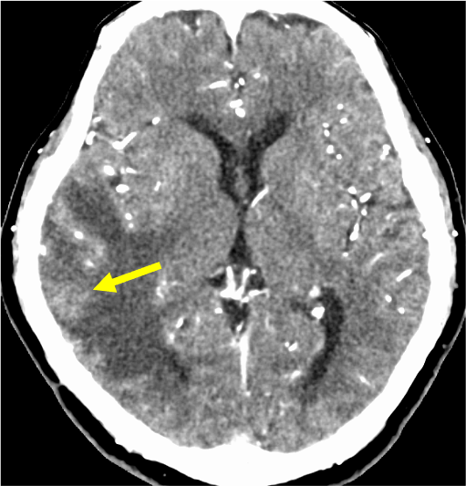 図2．造影CT動脈相