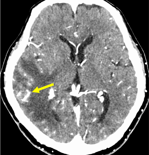 図3．造影CT静脈相