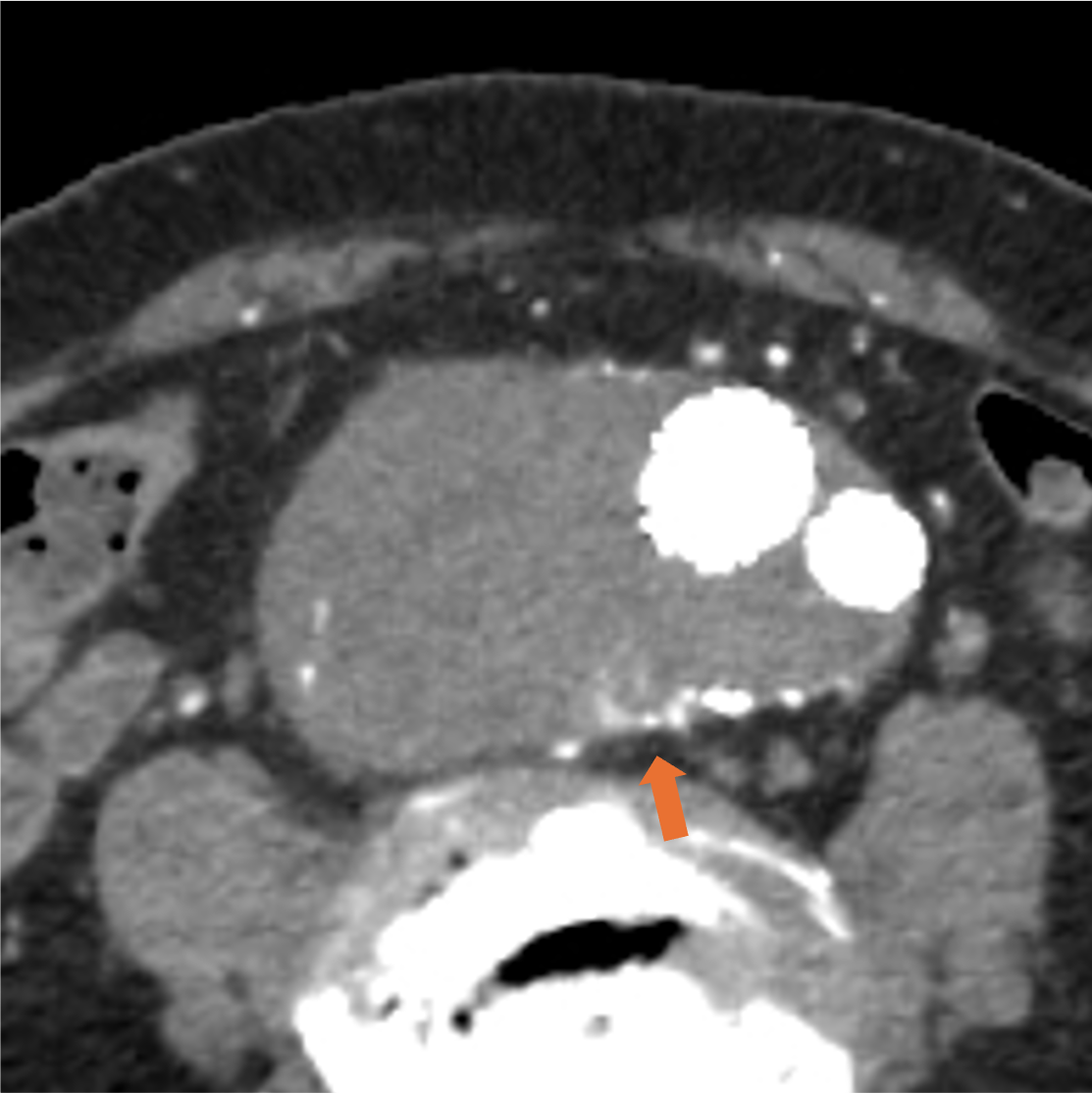 図１．動脈相 (120kV)