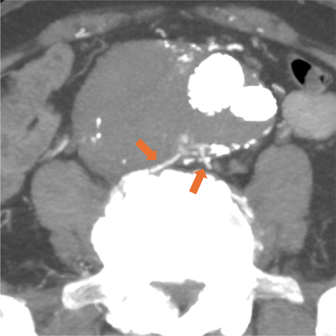 図2．動脈相 (120kV) (MIP)