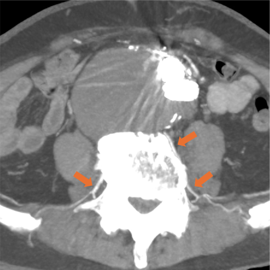 図3．動脈相 (120kV) (MIP)