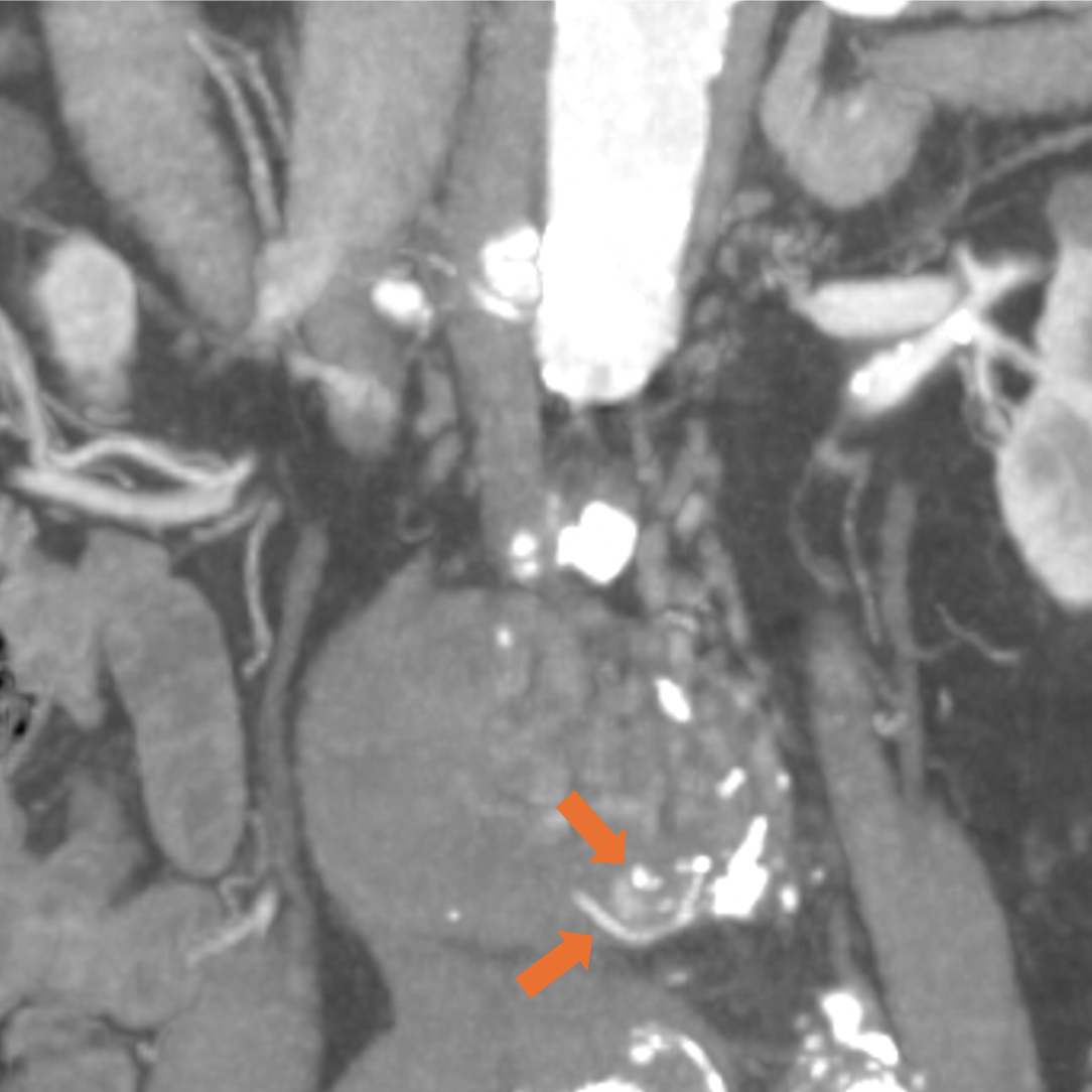 図4．動脈相 (120kV) (MIP/冠状断)