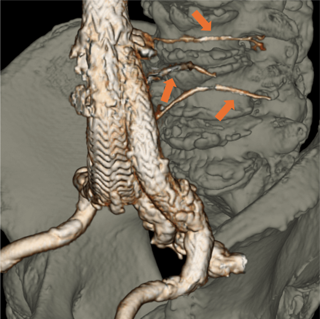 図5．動脈相 (120kV) (3D再構成)