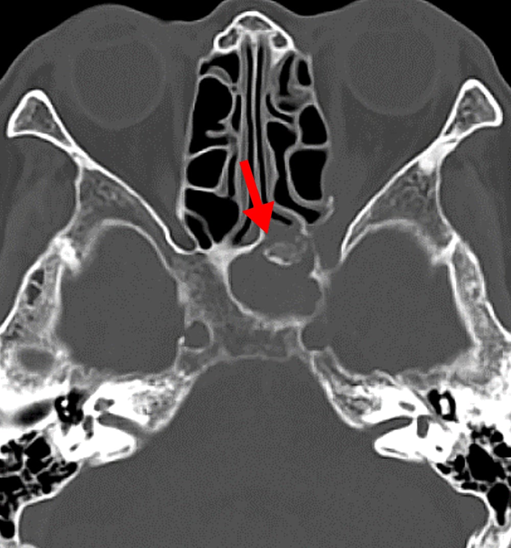 図１．単純(骨条件)