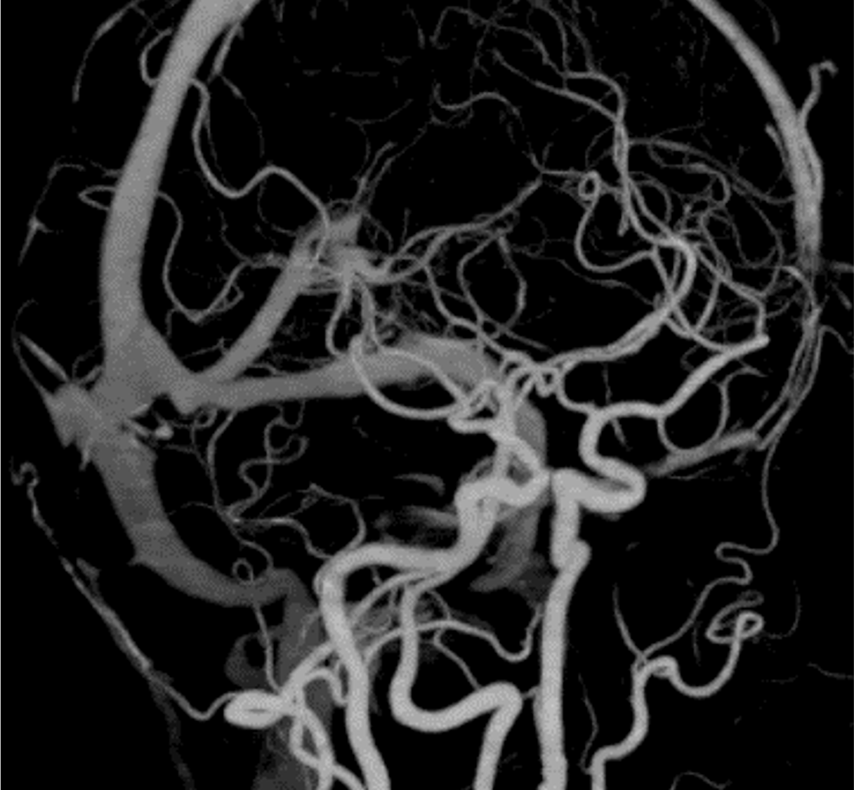 図3．早期動脈相（MIP）