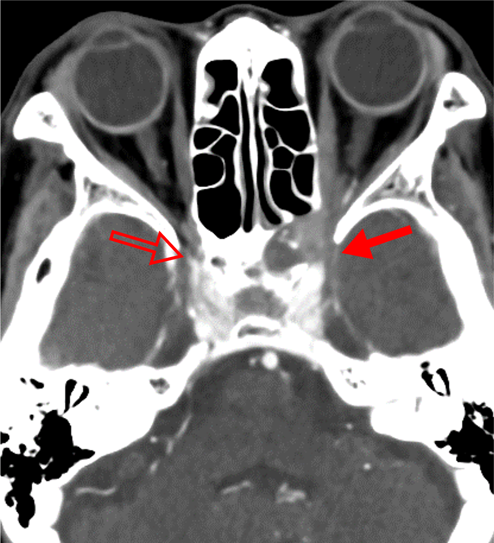 図4．後期動脈相