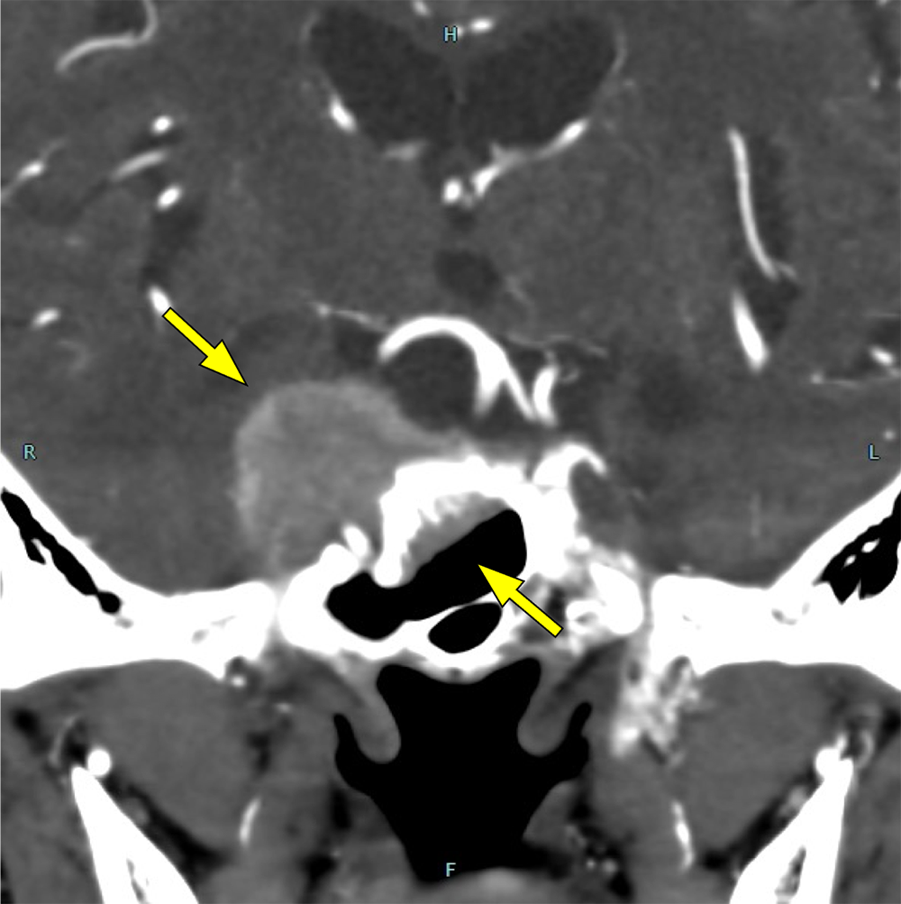 図2．造影CT(早期相)