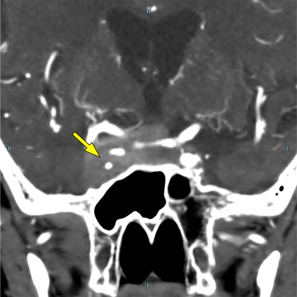図3．造影CT(早期相)