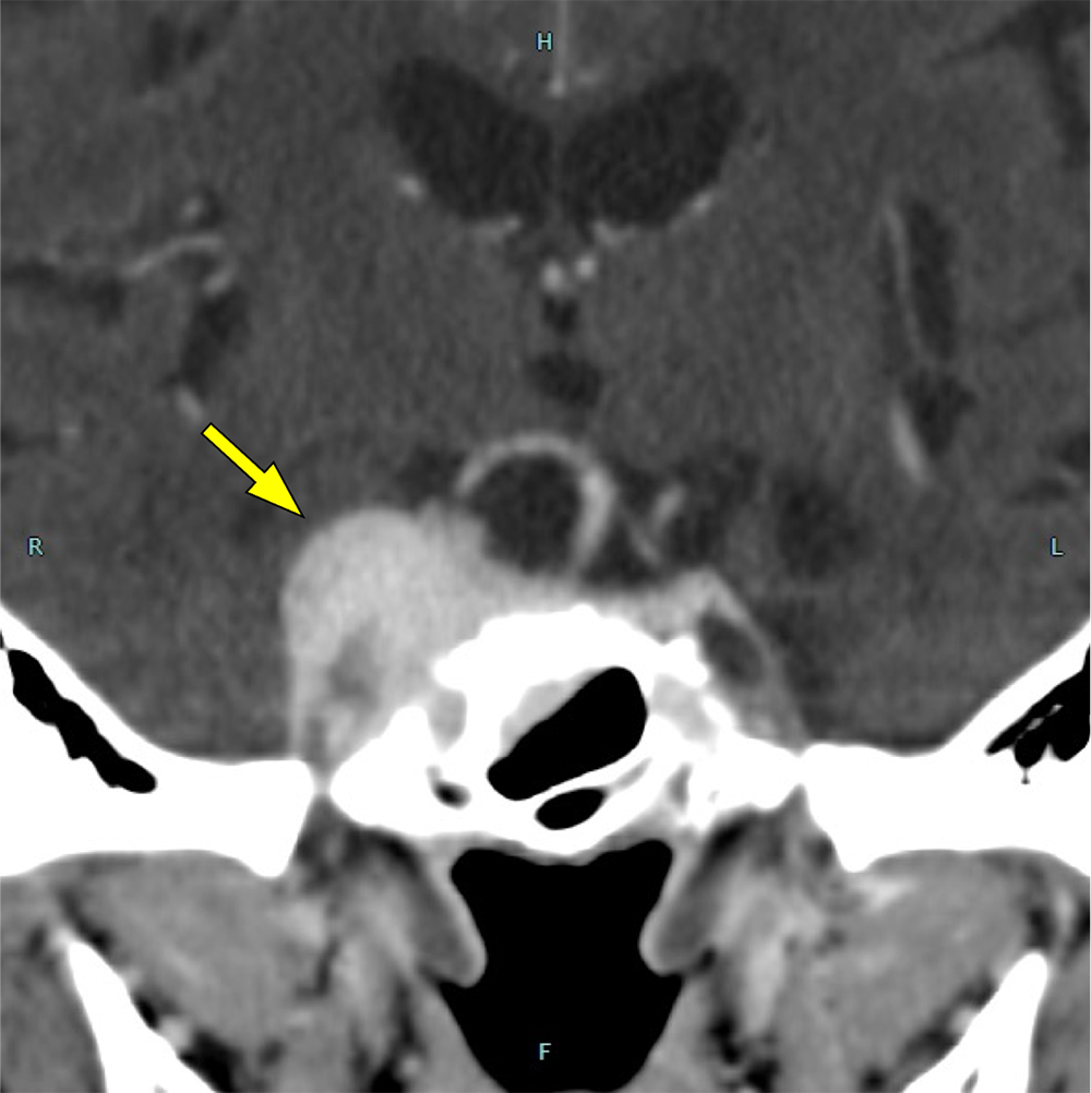 図5．造影CT(後期相)