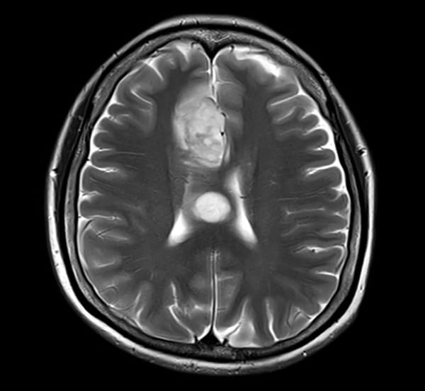 図2．T2強調画像