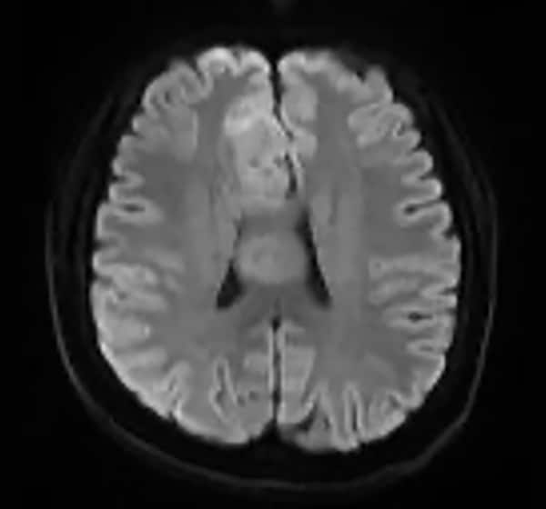 図4. 拡散強調画像