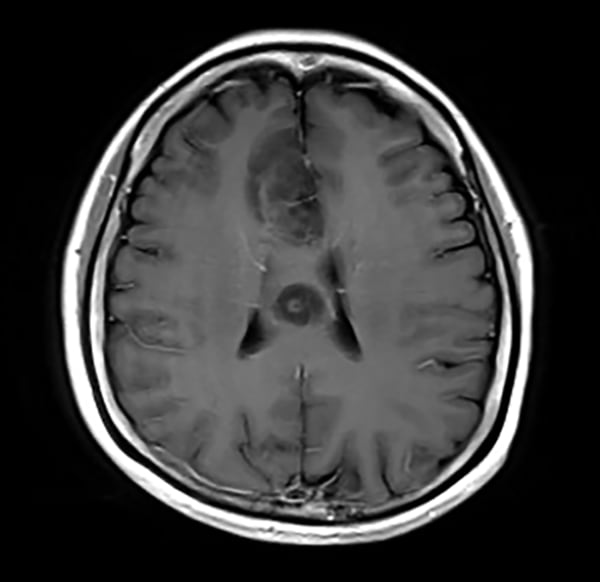 図6. 造影T1強調画像