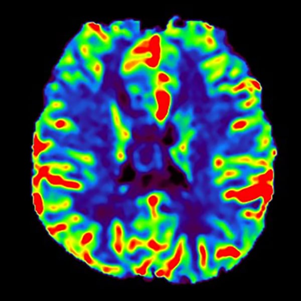 図7．DSC-Perfusion CBF画像
