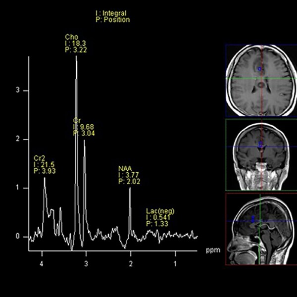 図8. MRスペクトロスコピー（TE135ms）