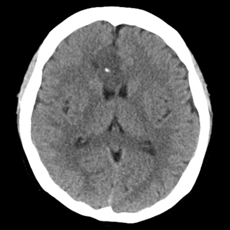 図9．Plain CT画像