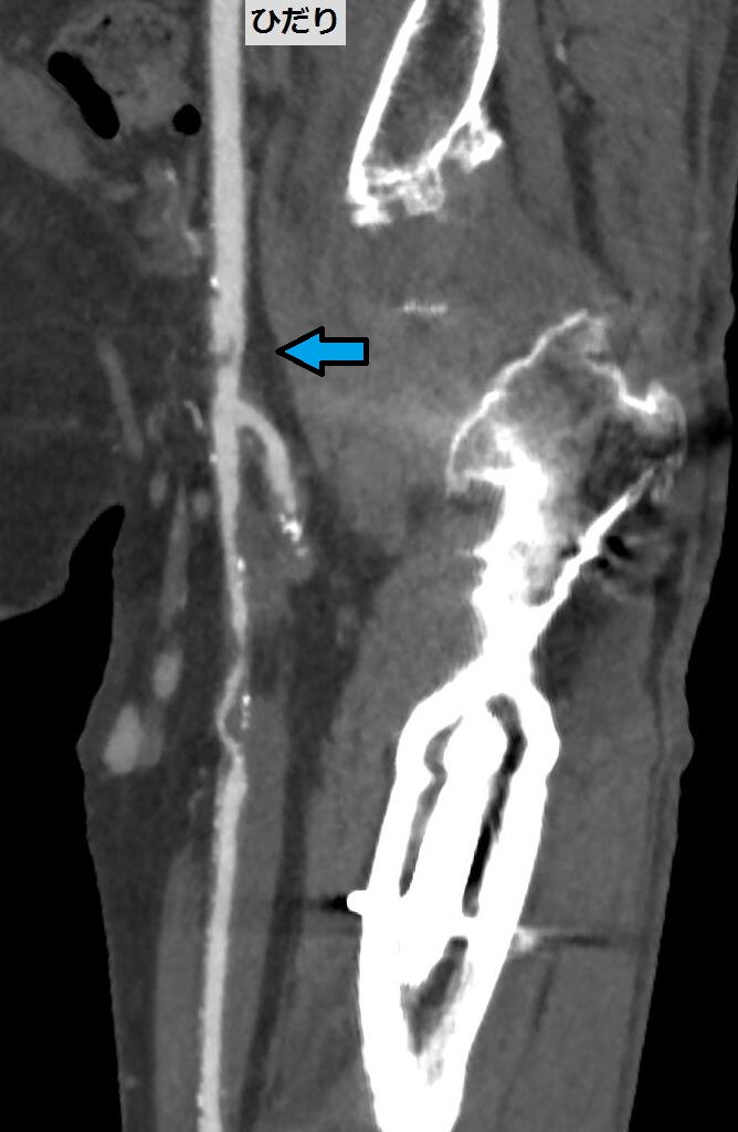 図2．下肢CTA　CFA
