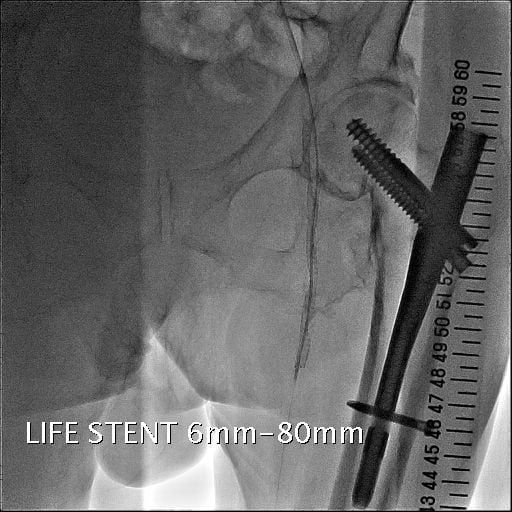 図5．SFAステント留置