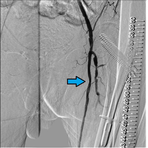 図7．SFA Post画像