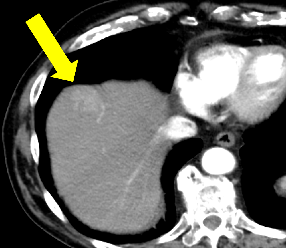 図１．早期動脈相