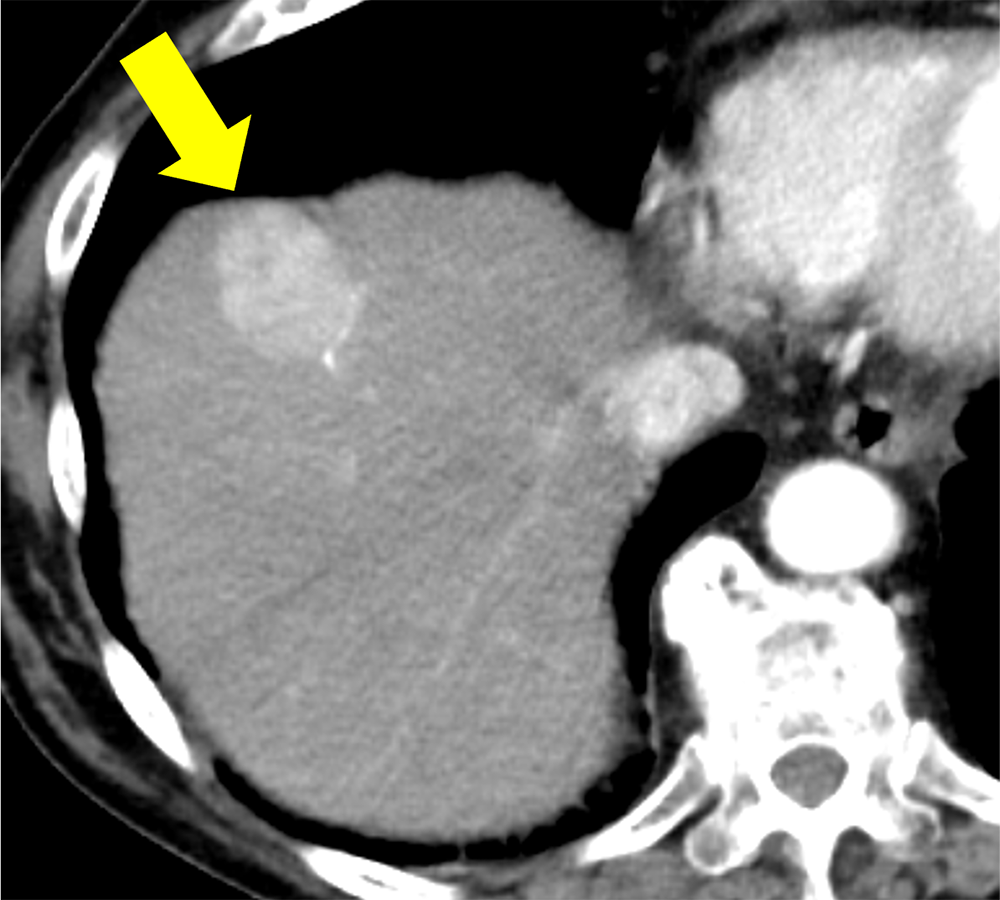 図2．後期動脈相