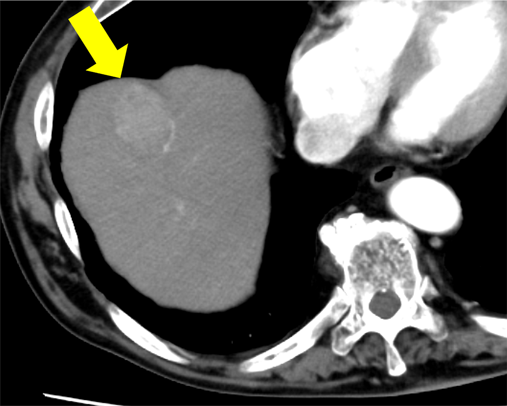 図3．後期動脈相（他院で撮像された通常注入法の画像）
