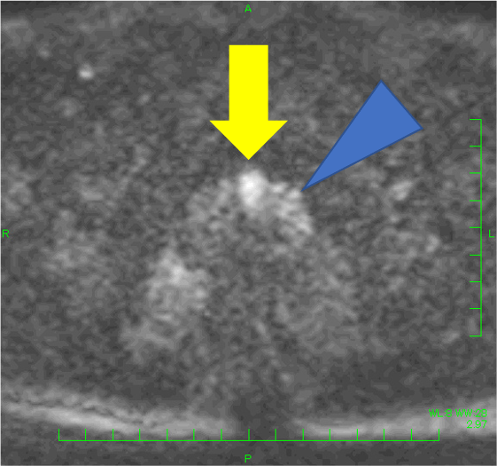 図2．拡散強調画像　b2000