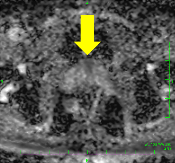 図3．Apparent Diffusion Coefficient（ADC）Map