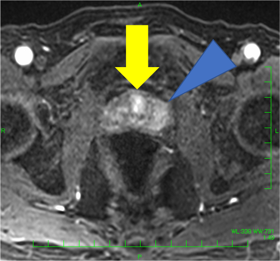 図5．ダイナミック造影　早期相