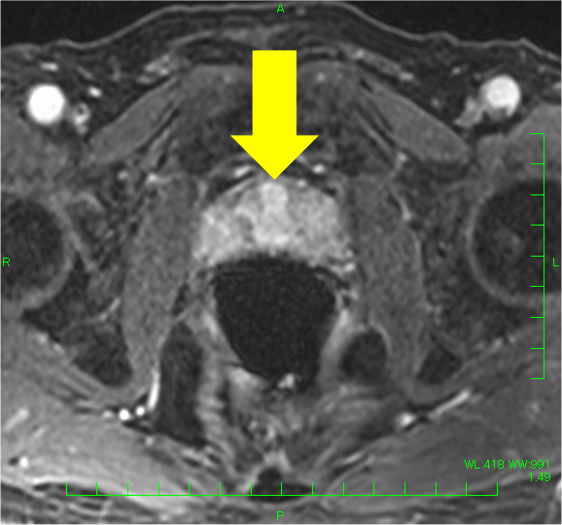 図6．ダイナミック造影　遅延相