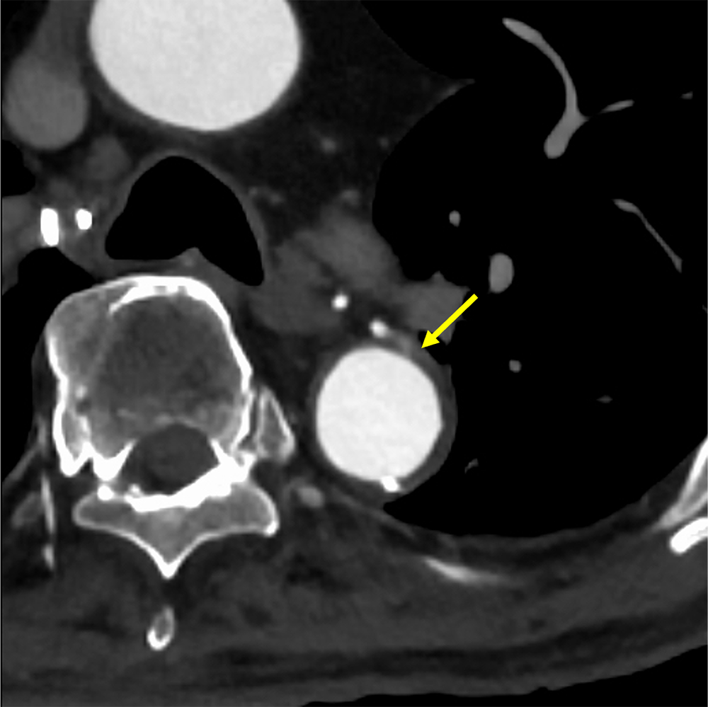 図１．体動脈相