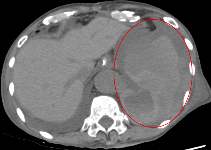 胸部急性大動脈解離に対する全弓部置換術後の活動性出血