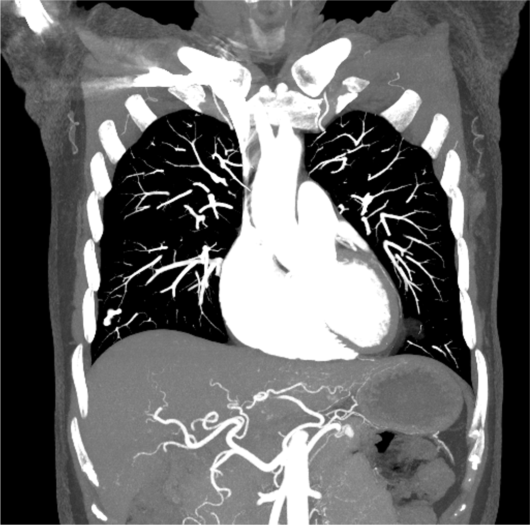図１．腹部造影CT動脈相（MIP像）