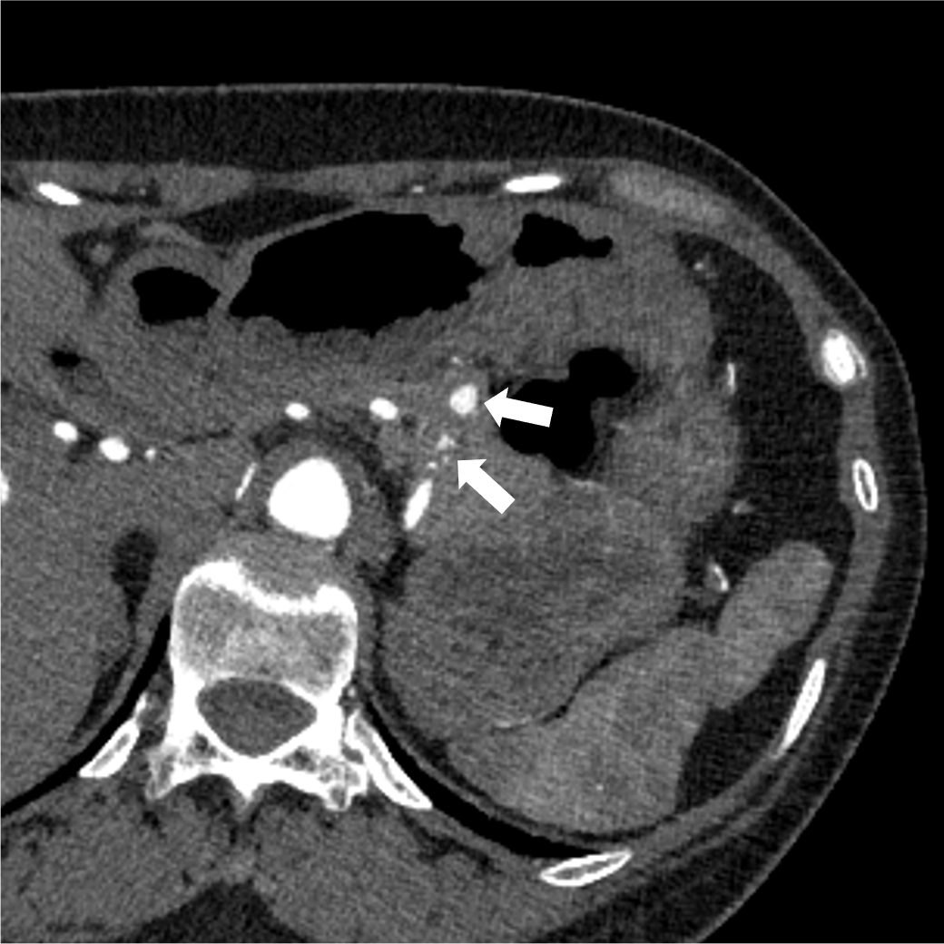 図2．腹部造影CT動脈相