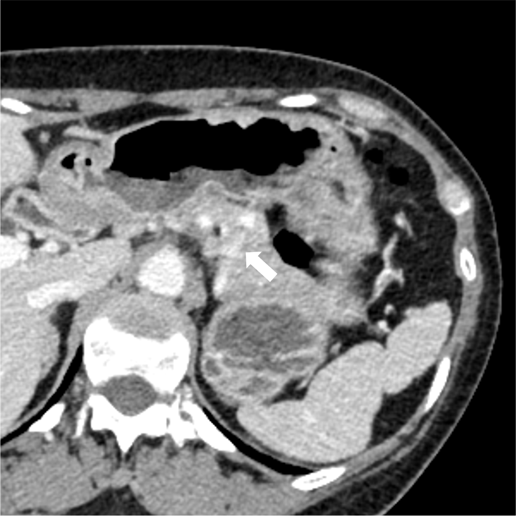 図3．腹部造影CT平衡相