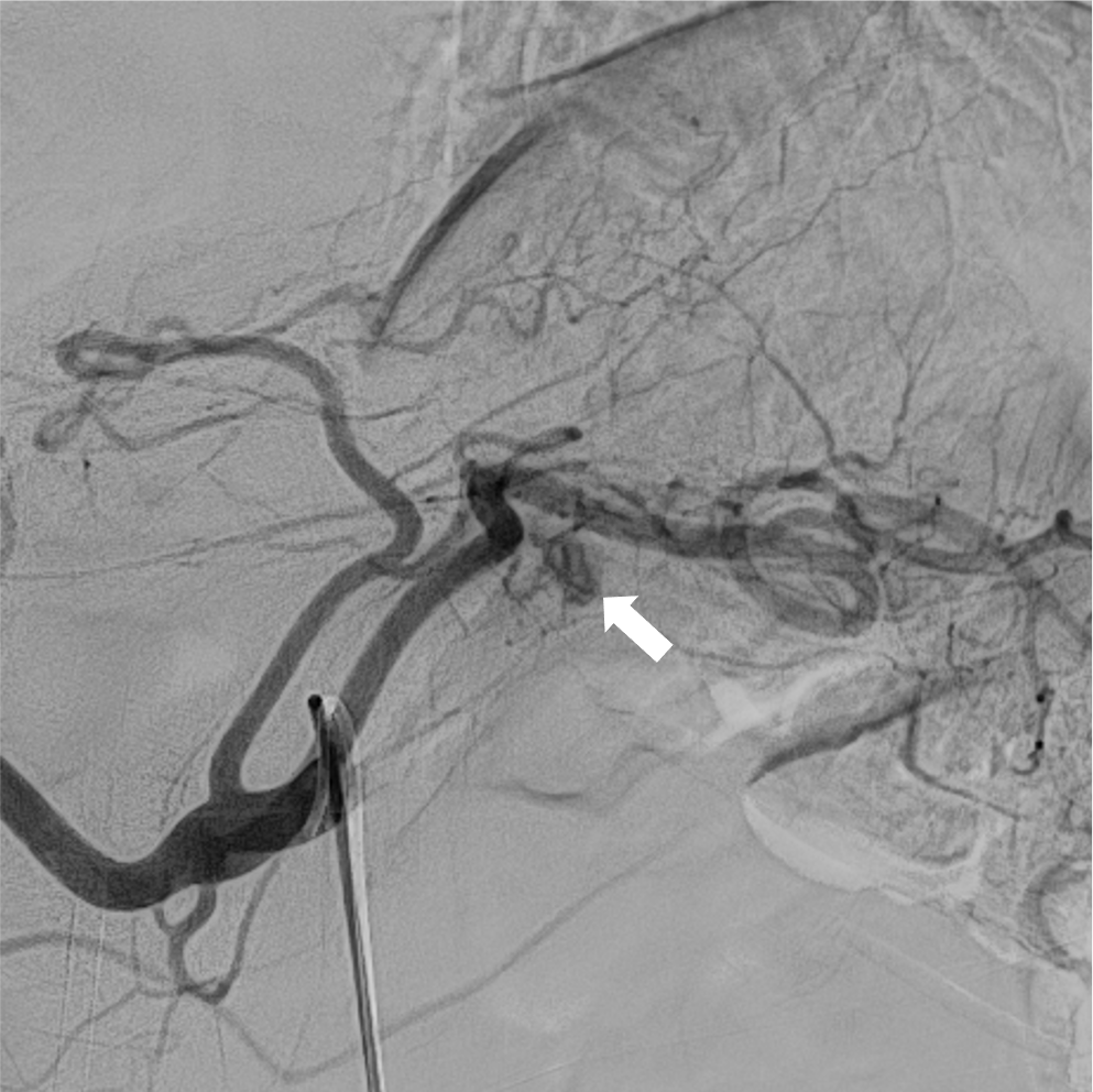 図4．腹腔動脈造影