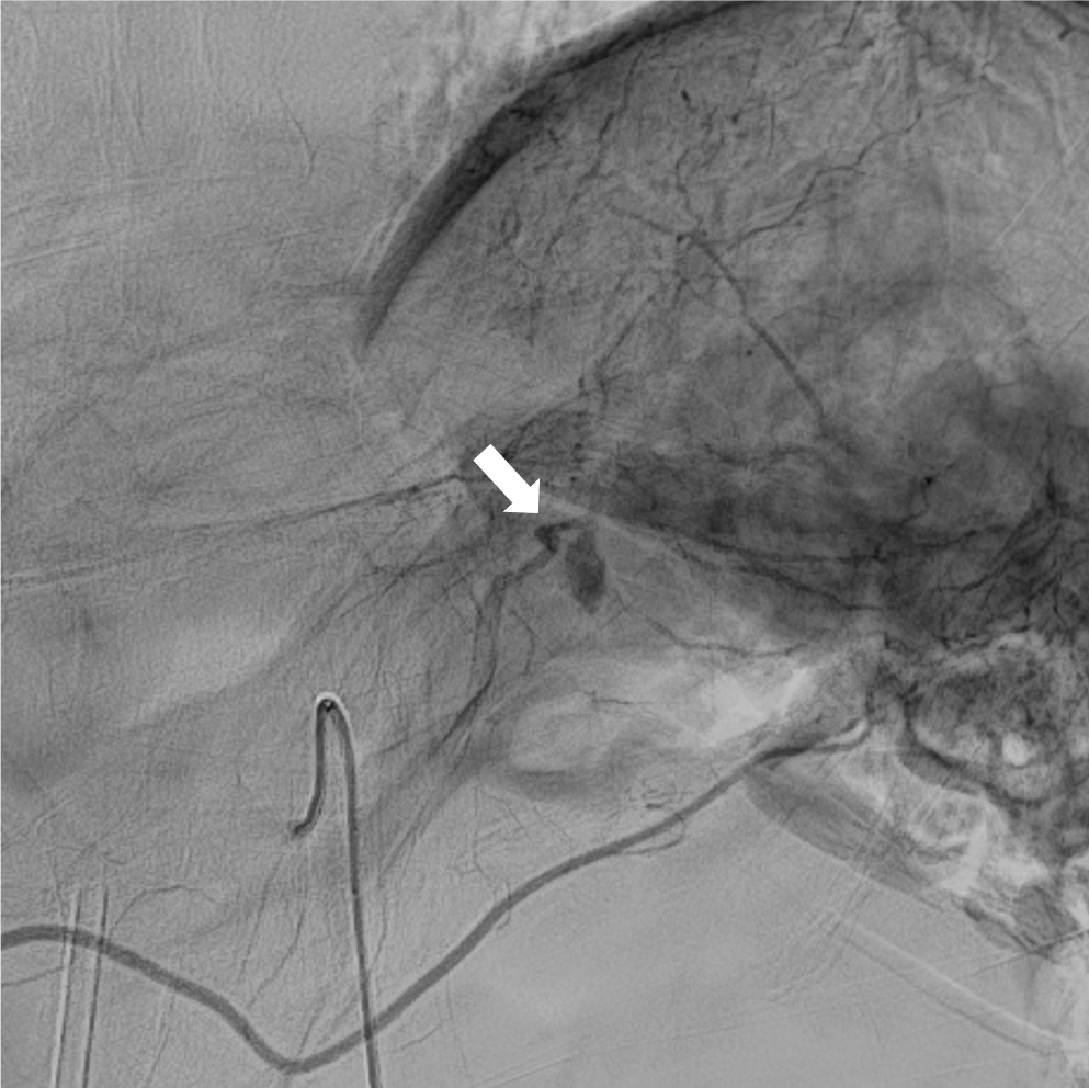 図5．腹腔動脈造影