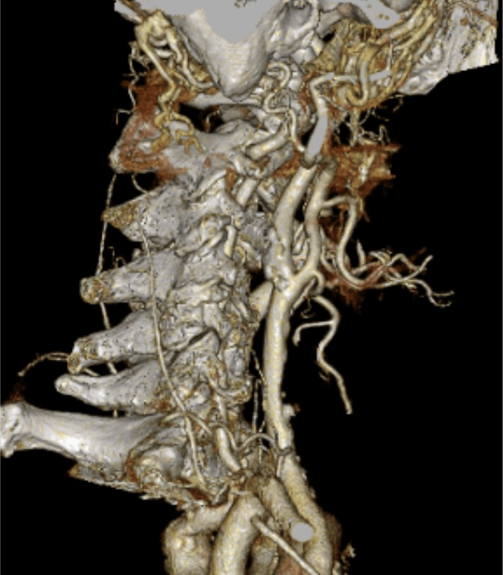 図１．動脈相　Volume rendering