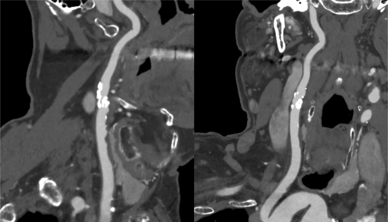 図2．動脈相　MIP