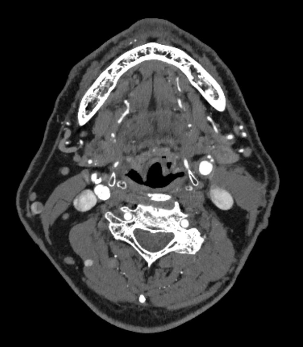 図3．動脈相　横断像