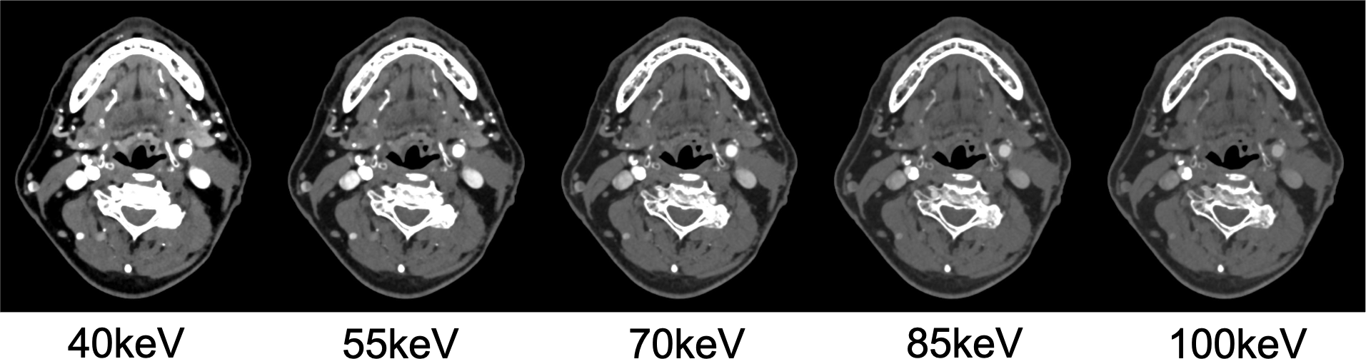 図4．Virtual Monoenergetic Image