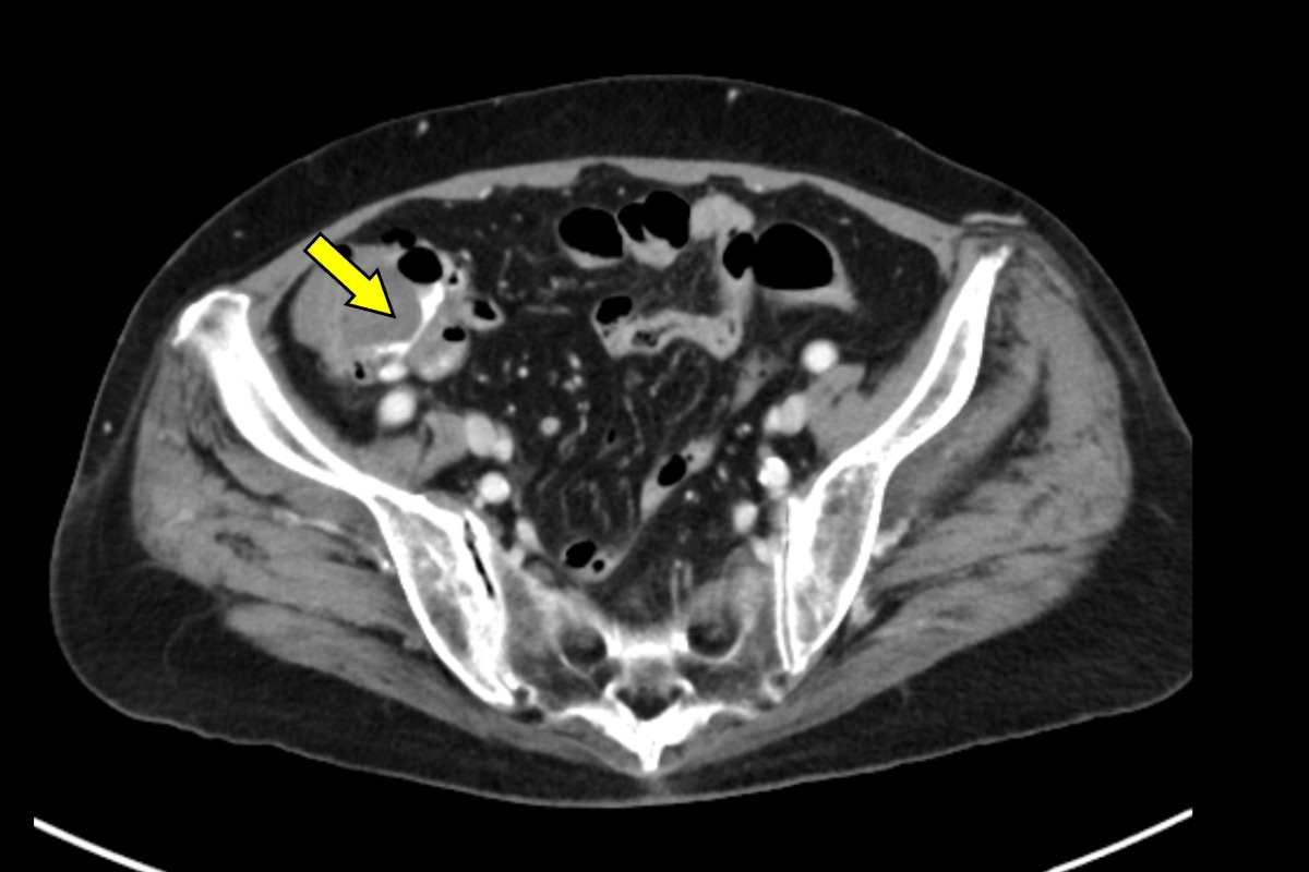 図2．横断像、平衡相