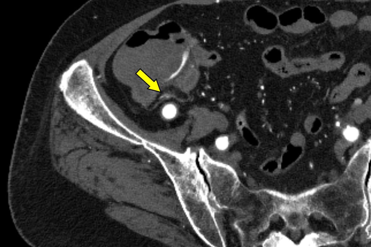 図3．横断像、動脈相